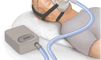 What is CPAP (Continuous Positive Airway Pressure) Therapy?