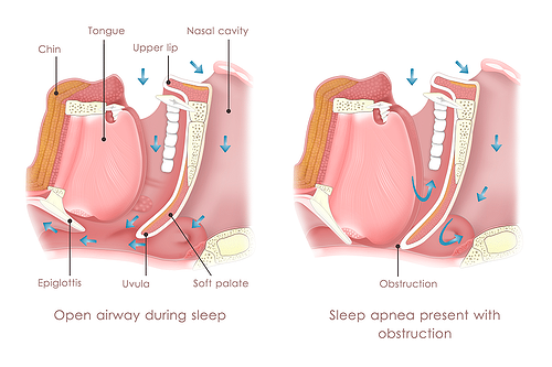 sleep apnea treatment options